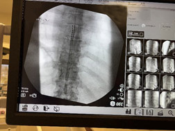 Spinal Cord Stimulator treatment in Ventura