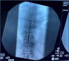 Spinal Cord Stimulator treatment in Ventura